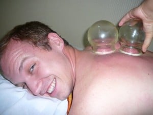 Chinese suction cups Chinese suction cups on my back