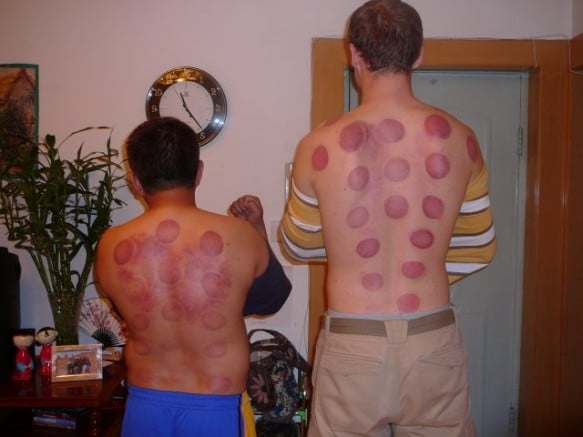 Hickey marks left from Chinese suction cup therapy, known as Chinese cupping;