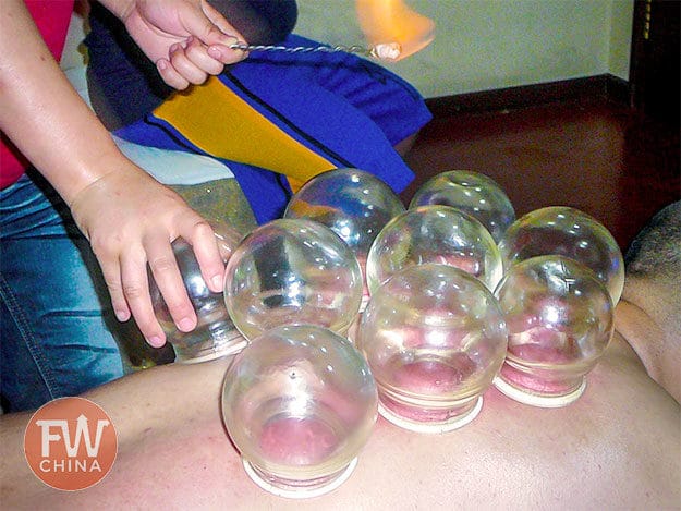 Chinese cupping, known as 拔罐 or Báguàn